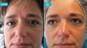 resultaat na 1 jaar deep cleansing, set en crème van !qms medicosmetics met ondersteuning van salonbehandelingen