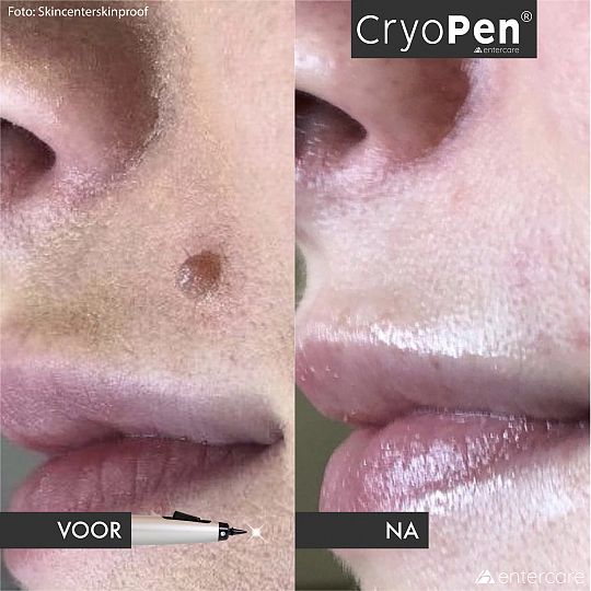 cryopen voor na mond skincenterskinproof.jpg