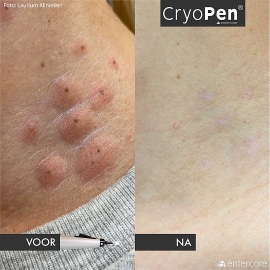 cryopen voor na nek lauriumklinieken.jpg