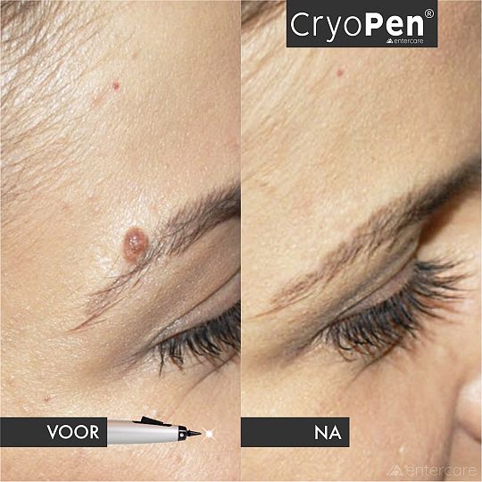 cryopen voor na oog vrouw.jpg